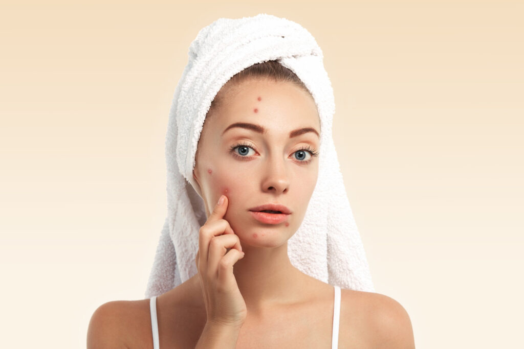 Acne: Causes, Treatment, and Prevention Strategies