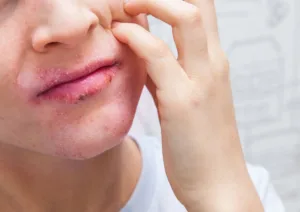 Eczema on lips