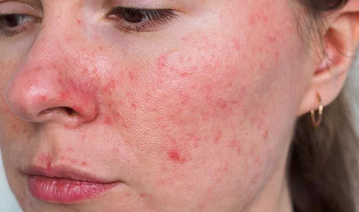 Rosacea: Understanding, Treatment, and Management Strategies