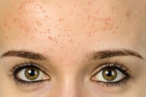 Forehead acne