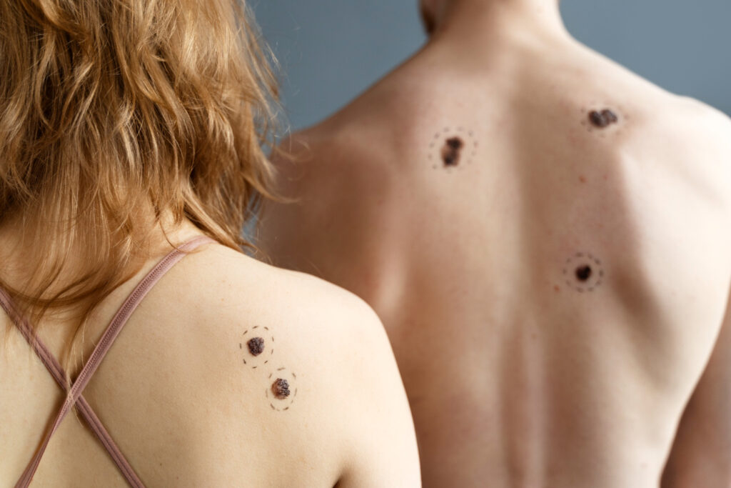 Skin Cancer: Understanding the Risks, Prevention, and Treatment