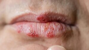 Blister on lip not cold sore