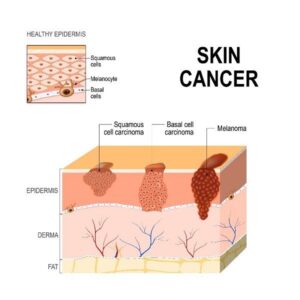 What is skin cancer?