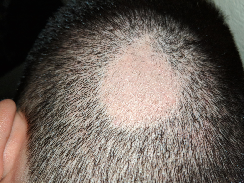 Alopecia Areata: Understanding and Managing Hair Loss