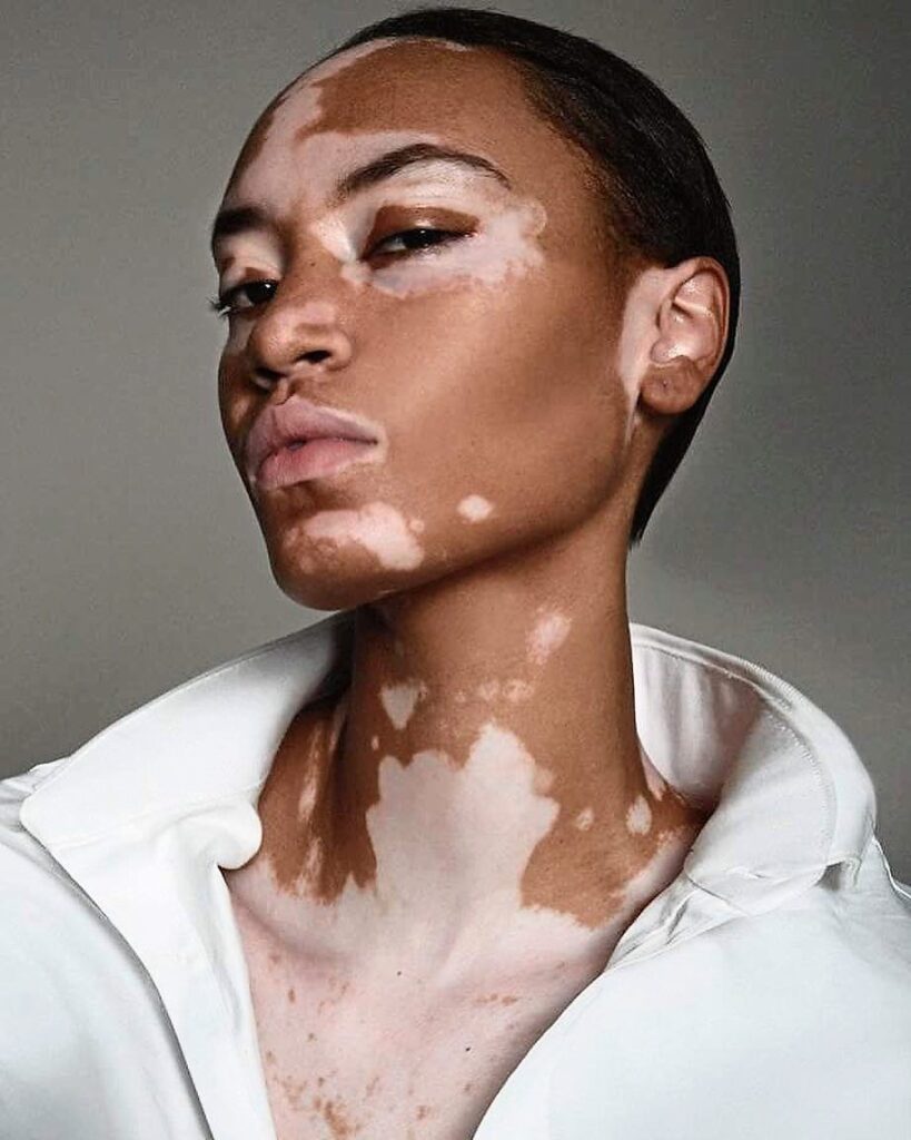 Vitiligo: A Complex Canvas of Skin and Identity