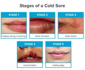 What does a cold sore look like?