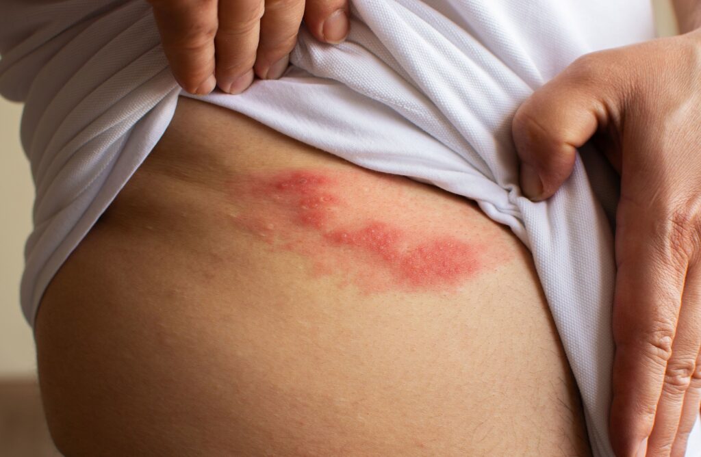 Shingles: How to Manage the Pain